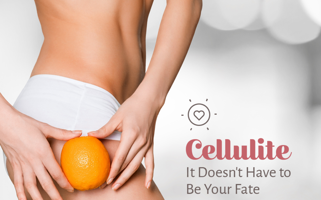 Cellulite—It Doesn’t Have to Be Your Fate